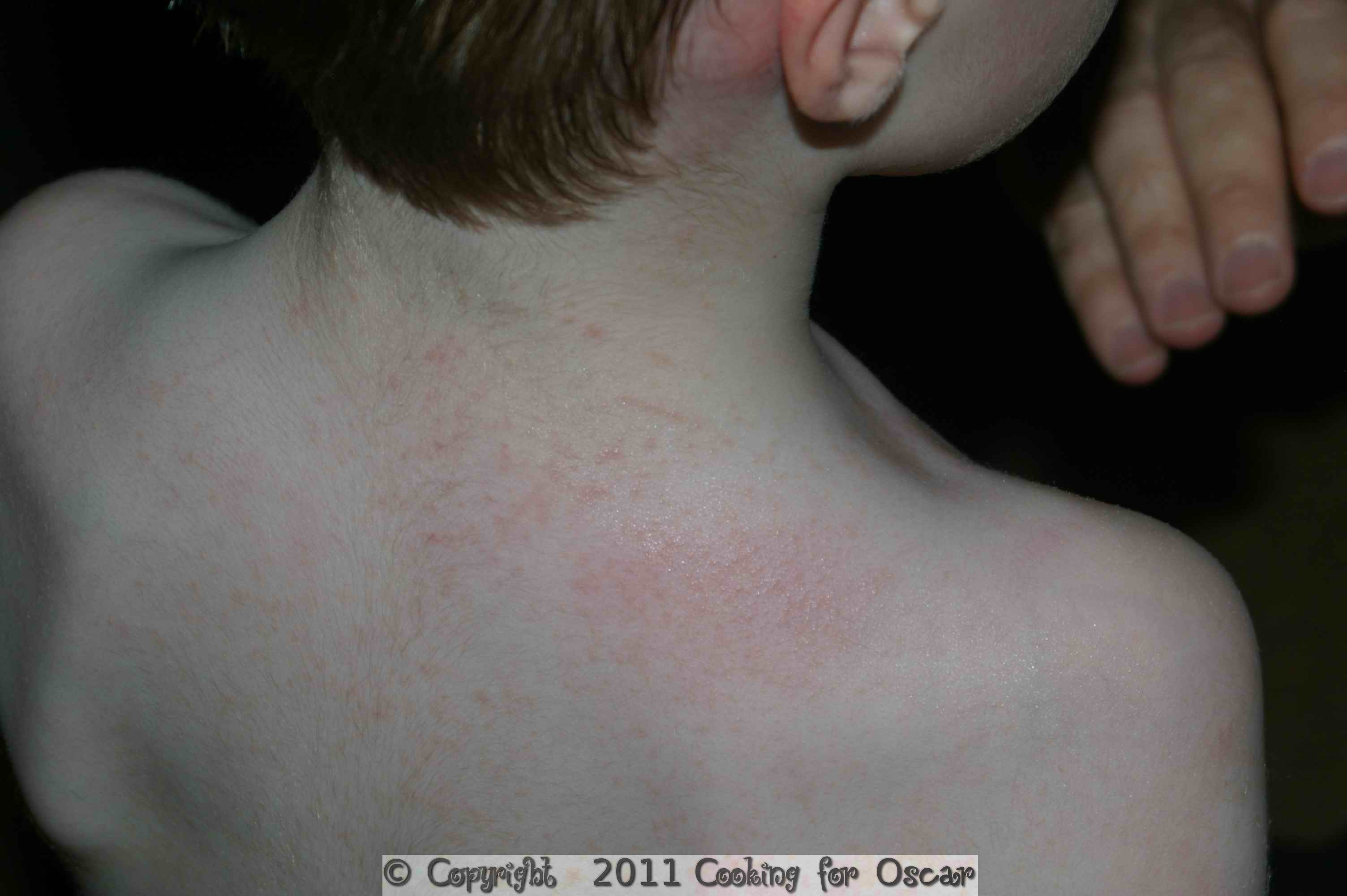 Eczema on shoulders
